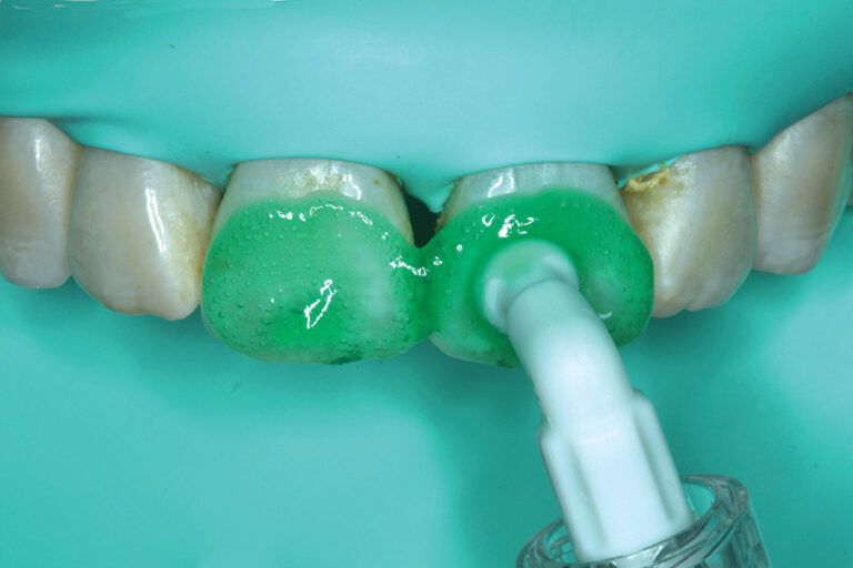 Resin Infiltration: A Minimally Invasive Treatment for White Spots on Teeth