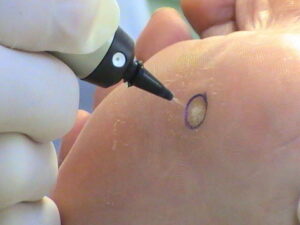 There are a couple of different ways to treat warts and veruccas in clinic.