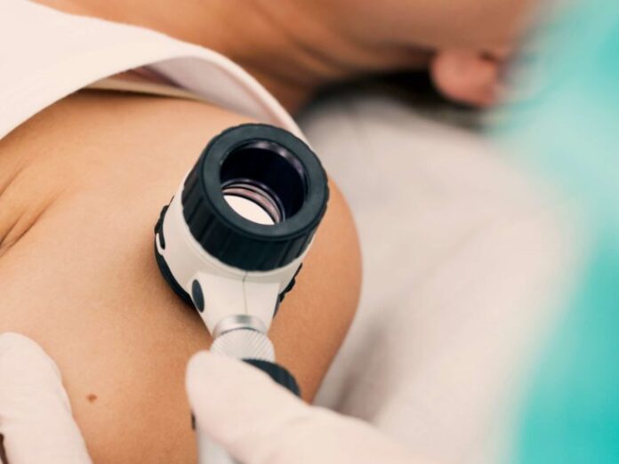 skin cancer