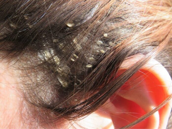 What Are the Causes of Dandruff?