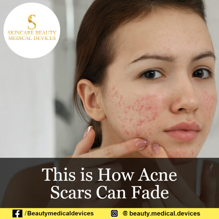 This is How Acne Scars Can Fade