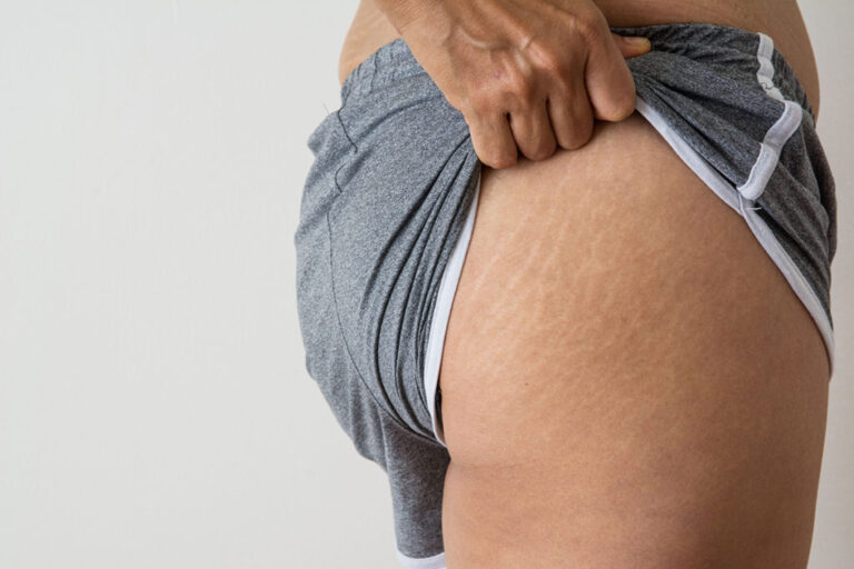 Best Way to Remove Stretch Marks: LASER STRETCH MARK REMOVAL