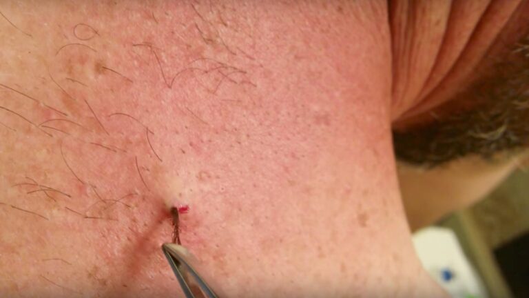 Know About Ingrown Hairs And How You Should Deal With It