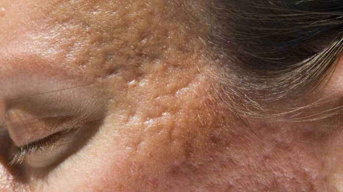 How Is MORPHEUS8 RF Micro-needling Replacing Plastic Surgery?