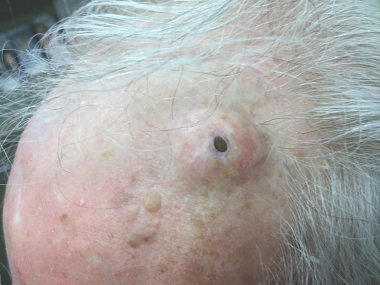 What Is a Dilated Pore of Winer: Causes, Treatment and Prevention