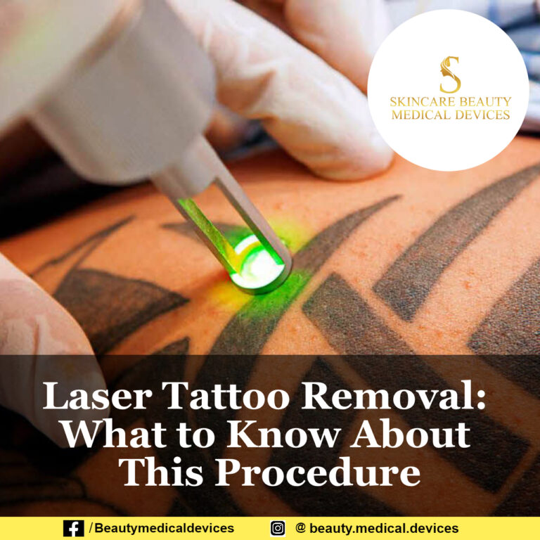 Laser Tattoo Removal: What to Know About This Procedure
