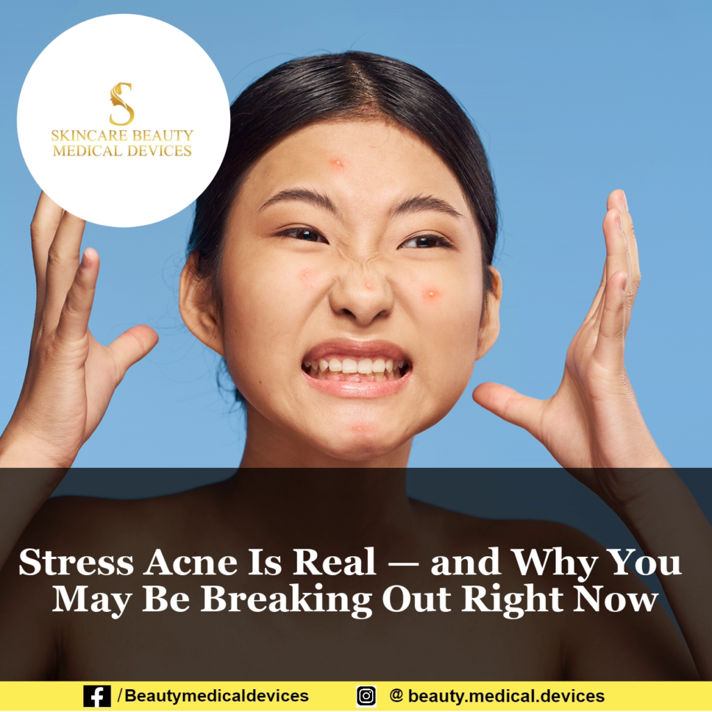 stress-acne-is-real-and-why-you-may-be-breaking-out-right-now