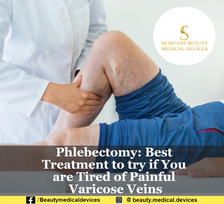 Phlebectomy: Best treatment to try if You are tired of Painful Varicose Veins
