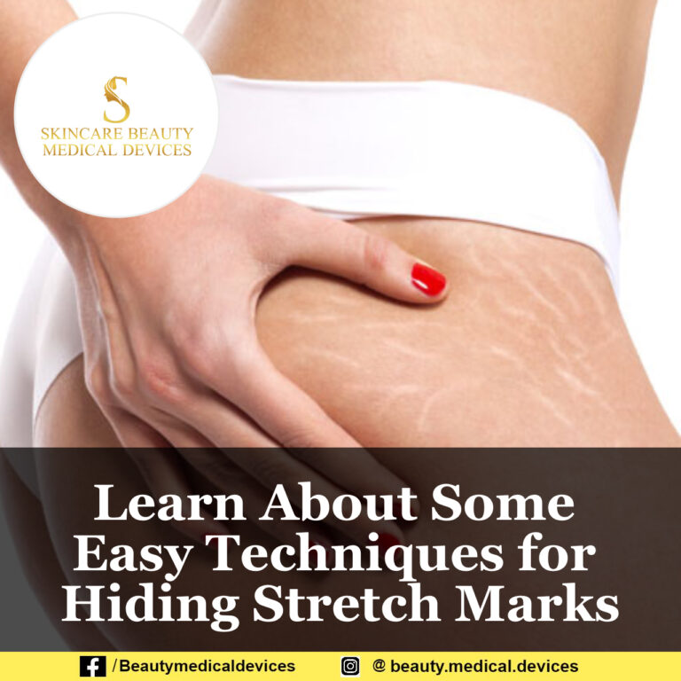 Learn About Some Easy Techniques for Hiding Stretch Marks