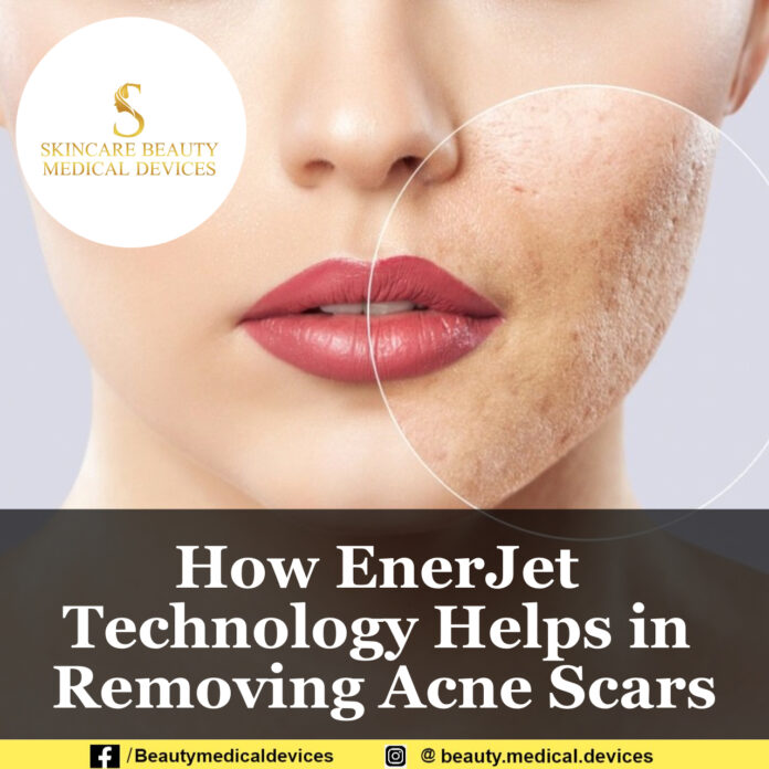 How EnerJet Technology Helps in Removing Acne Scars