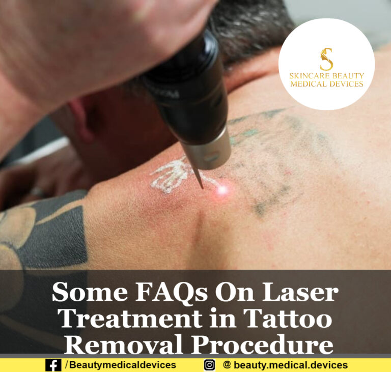 Some FAQs On Laser Treatment in Tattoo Removal Procedure