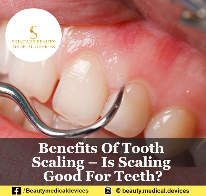 Benefits Of Tooth Scaling Is Scaling Good For Teeth?