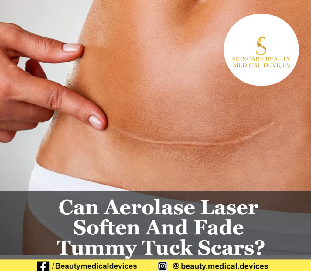 Can Aerolase Laser Soften And Fade Tummy Tuck Scars?