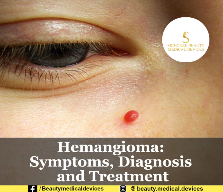 Hemangioma: Symptoms, Diagnosis and Treatment