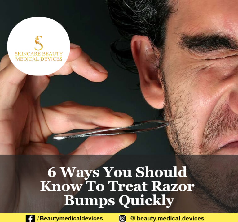 6 Ways You Should Know To Treat Razor Bumps Quickly