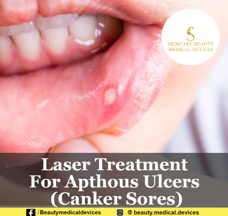 Laser Treatment For Apthous Ulcers (Canker Sores)