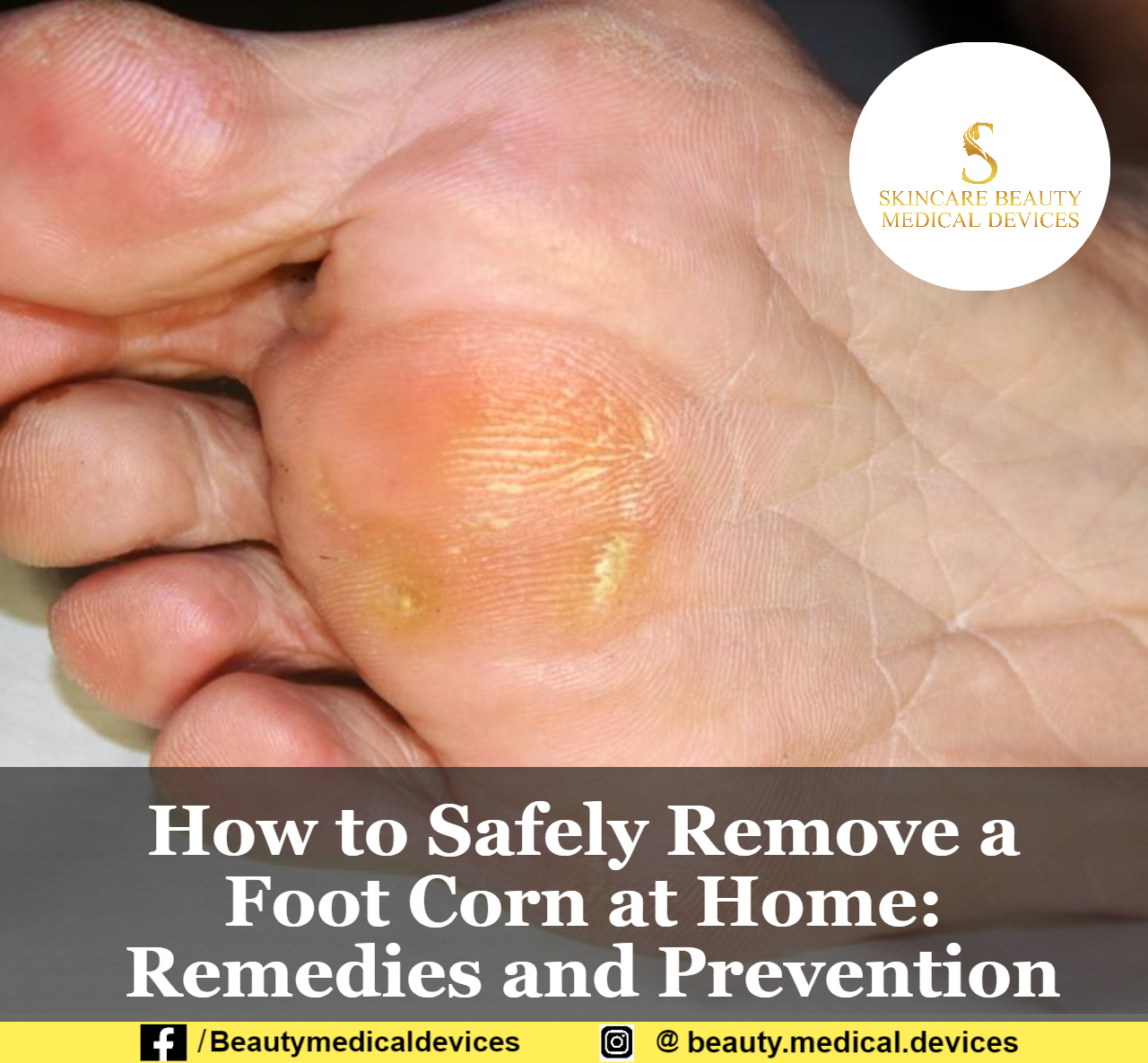 how-to-safely-remove-a-foot-corn-at-home-remedies-and-prevention