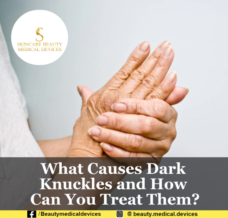 What Causes Dark Knuckles and How Can You Treat Them?