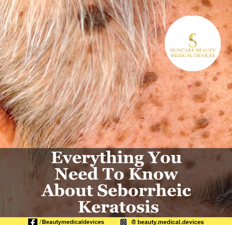 All You Need To Know About Skin Lesion called Seborrheic Keratosis
