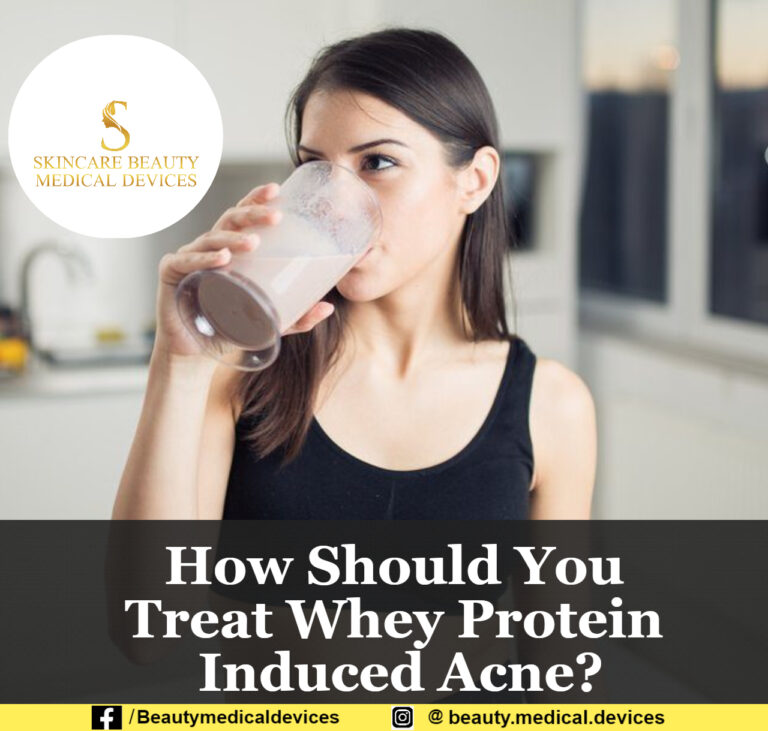 How Should You Treat Whey Protein Induced Acne?