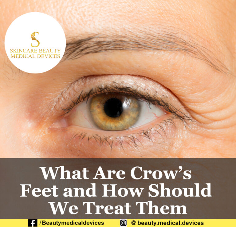 What Are Crow’s Feet and How Should We Treat Them