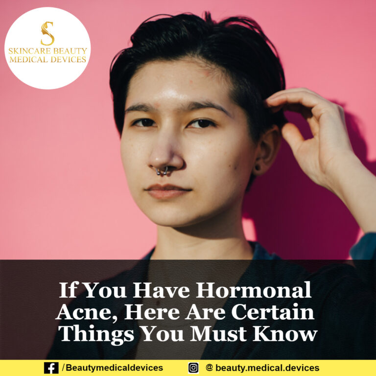 If You Have Hormonal Acne, Here Are Certain Things You Must Know