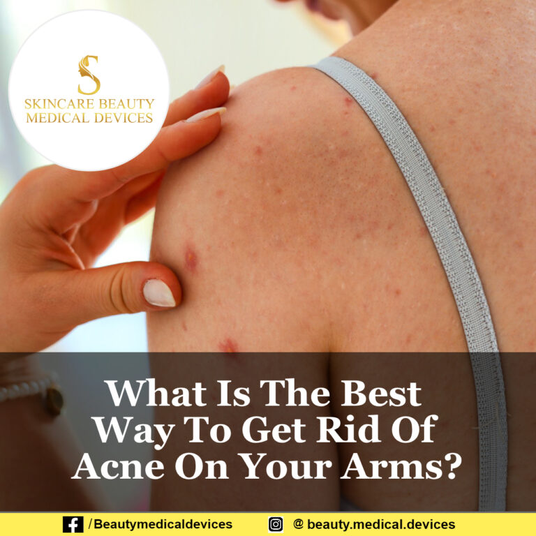 What Is The Best Way To Get Rid Of Acne On Your Arms?