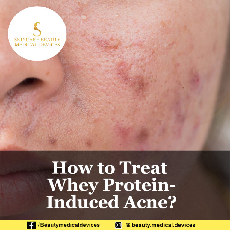 How to Treat Whey Protein-Induced Acne?