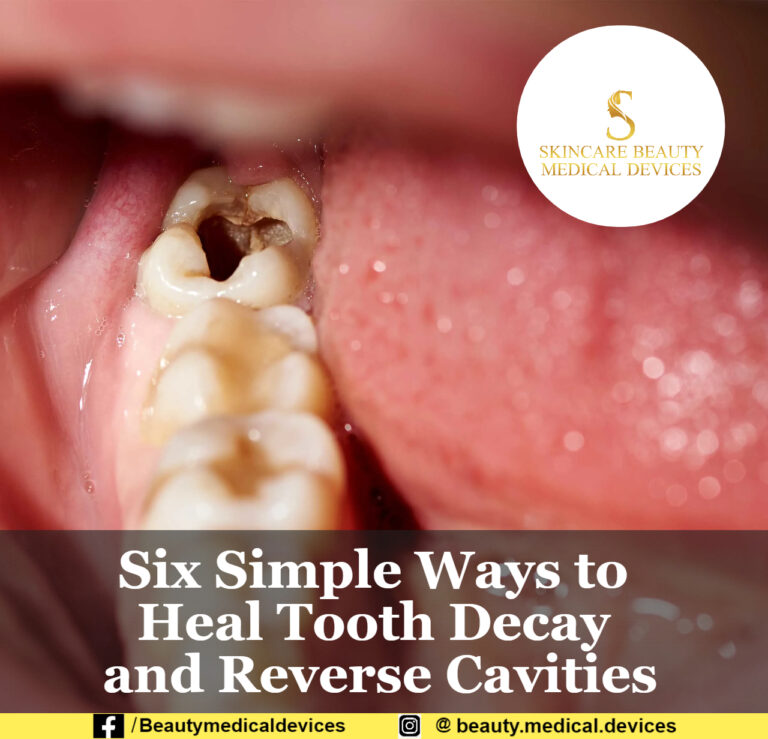 Six Simple Ways to Heal Tooth Decay and Reverse Cavities