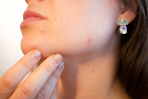 Association of Blue Light and Sonic Vibration to At-Home Acne Treatment