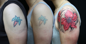 Getting a Tattoo Removed: What to Know About This Procedure?