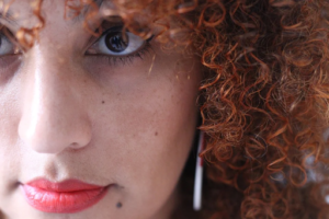 Treatments Of Melasma – What Techniques Are Effective?