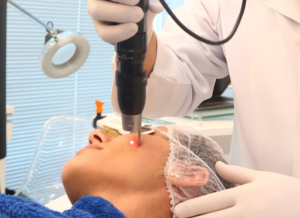 Treatments Of Melasma – What Techniques Are Effective?