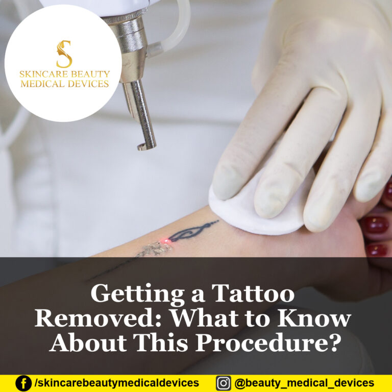 Getting a Tattoo Removed: What to Know About This Procedure?