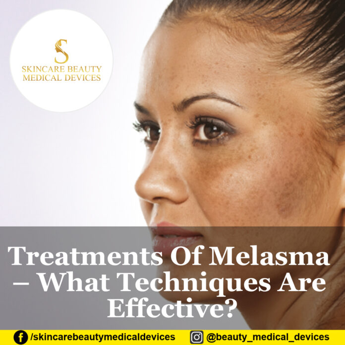 Treatments Of Melasma – What Techniques Are Effective?