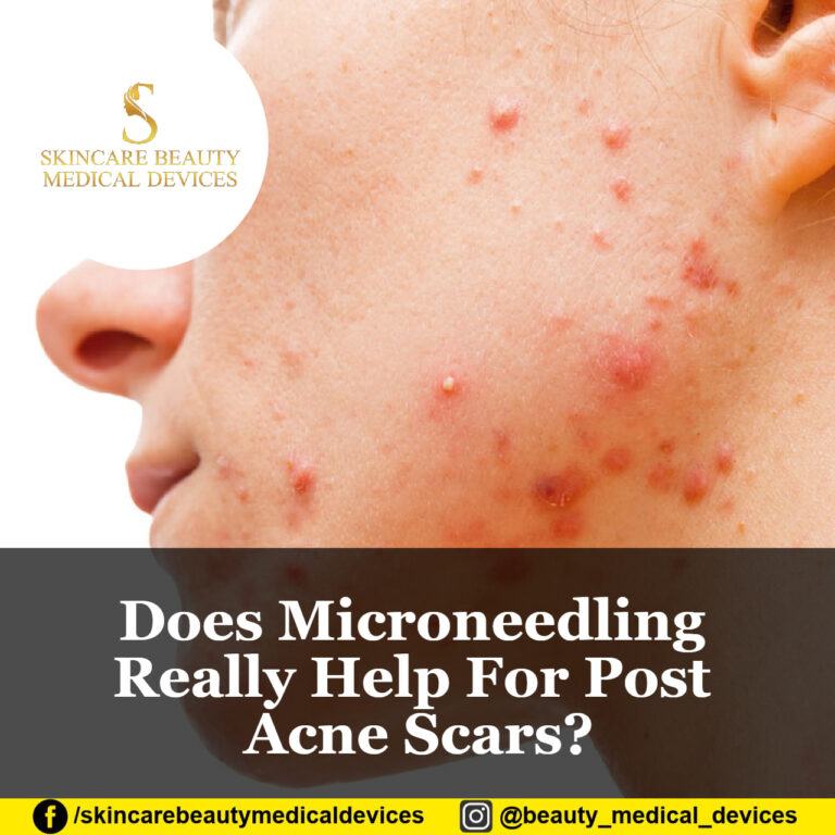 Does Microneedling Really Help For Post Acne Scars?