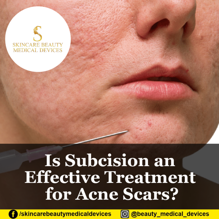 Is Subcision an Effective Treatment for Acne Scars?