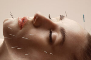 beauty acupuncture