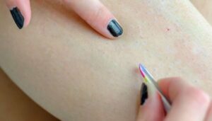 ingrown hair