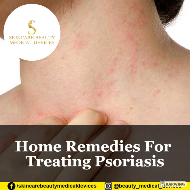 Home Remedies For Treating Psoriasis