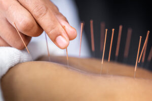 acupuncture therapy