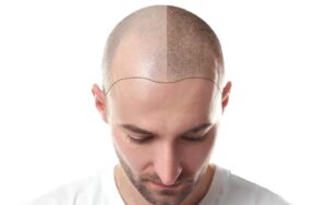 Scalp 