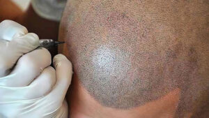 scalp tattoo
