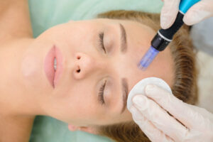 5 Reasons Micro-needling Is Beneficial For Your Skin