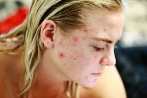 How To Measure The Stress That Affects Your Skin