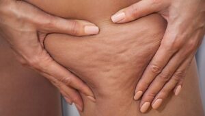A Device To Treat Body Cellulite And Provide Anti-Aging Massage At The Same Time