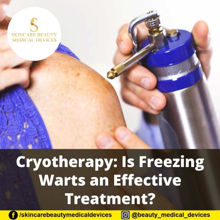 Cryotherapy: Is Freezing Warts an Effective Treatment?