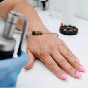 Cryotherapy: Is Freezing Warts an Effective Treatment?