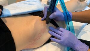 What Makes Scar Camouflage a Great Treatment Option?