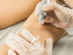 What Makes Scar Camouflage a Great Treatment Option?